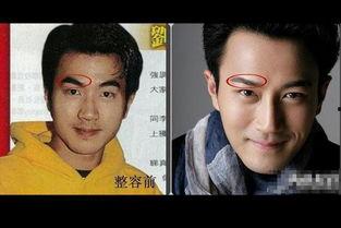 男士整容照片,揭秘男士整容前后对比照